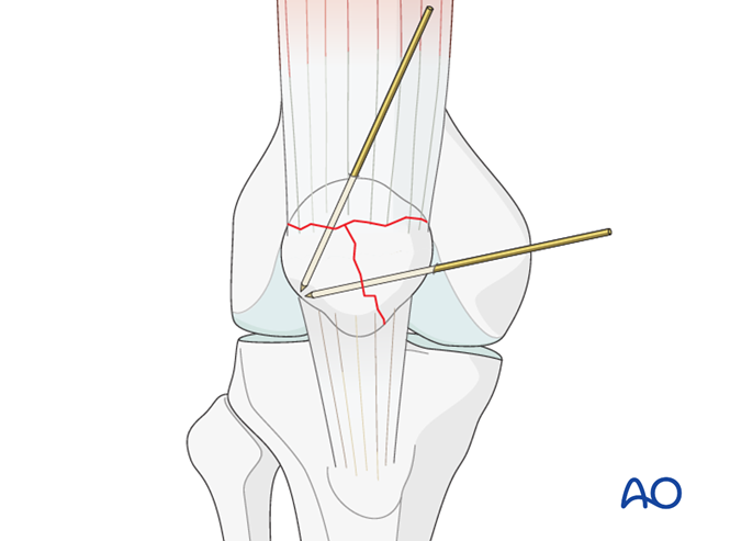 Patellar plating for Complete articular, frontal/coronal wedge fracture