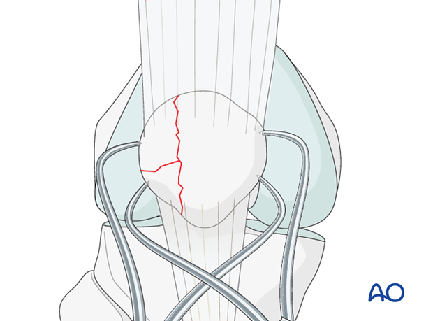 suture anchors