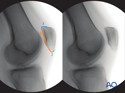 Patellar Accessory Ridge Intraoperative imaging of the patella