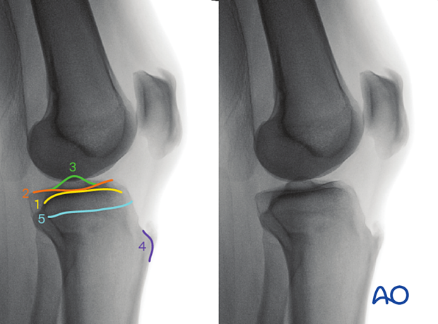 41_X552_i060 Anatomical landmarks and lines in the optimal lateral view of the proximal tibia