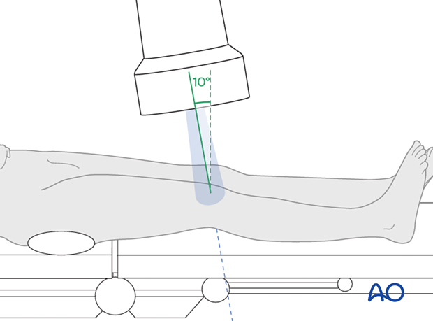 41_X552_i070 Positioning for optimal AP view of the proximal tibia with 10° cephalic tilt