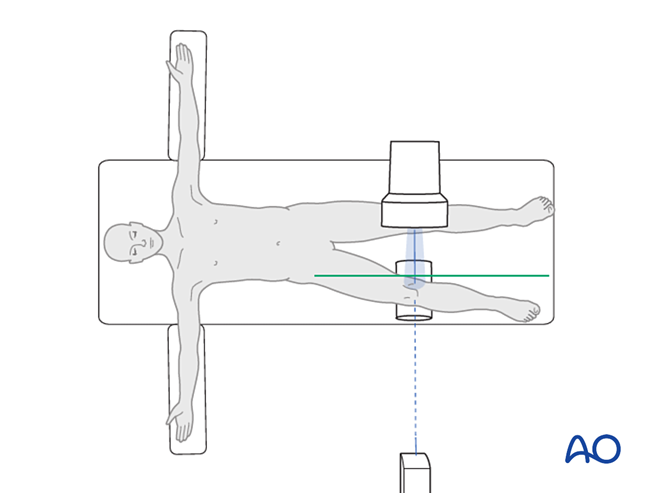 Intraoperative imaging of the proximal tibia