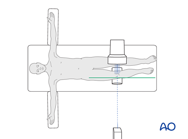41_X552_i120 Positioning for optimal modified lateral view to evaluate the medial plateau
