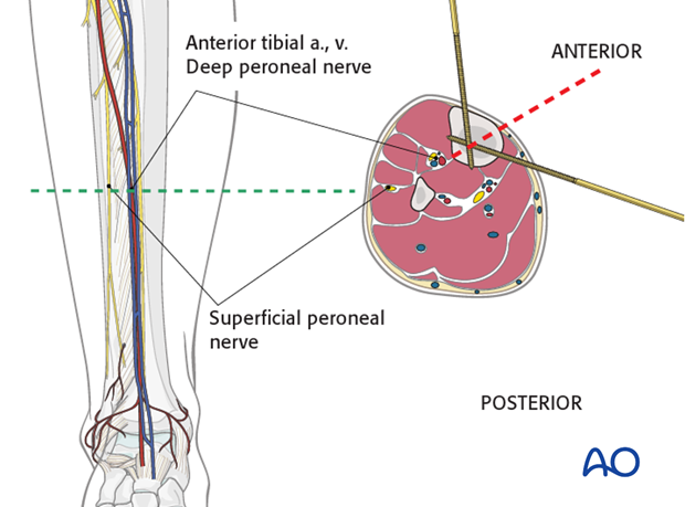 Circular external fixator application for midshaft tibial