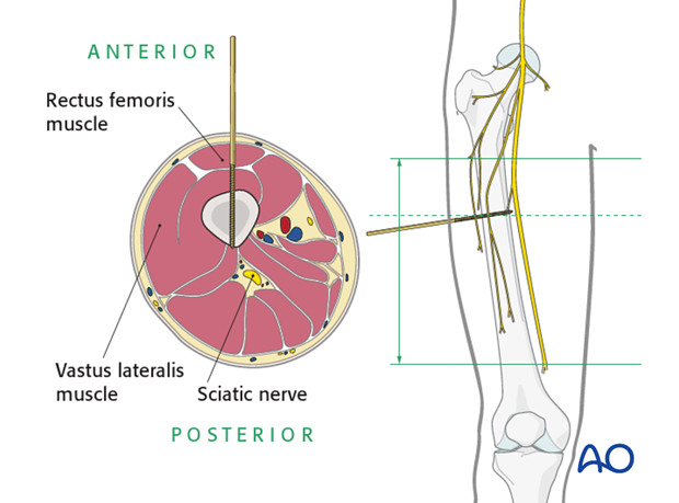 Circular external fixator application for midshaft tibial