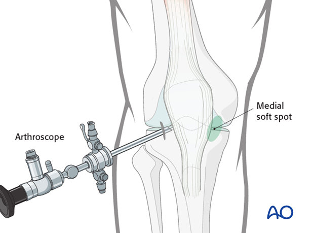 Arthroscopic approach to the knee