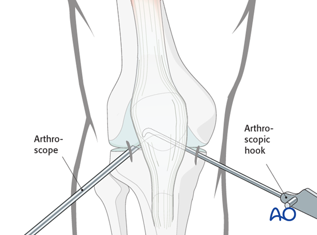 arthroscopic approach to the knee