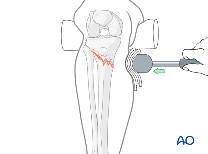 MIO - Angular stable plate (LISS) for Extraarticular fracture ...