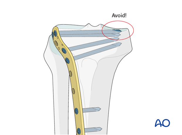 When inserting screws from lateral to medial this fact must be taken into consideration.