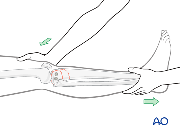 Reduce the metaphyseal component by pulling on the leg and restore axial alignment, length, and rotation.