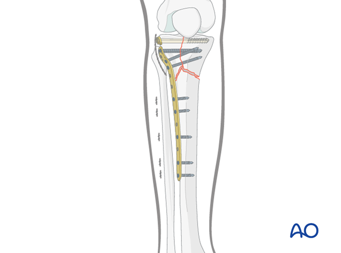 ORIF - Plates without angular stability for Complete articular fracture ...