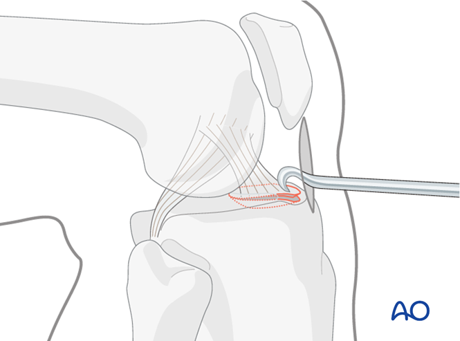 Lag Screws For Extraarticular Fracture, Avulsion Of Tibial Spine