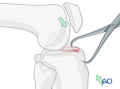 Lag screws for Extraarticular fracture, avulsion of tibial spine