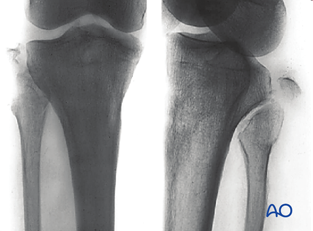 Fibular head