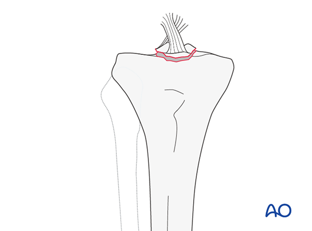 Tibial spine (AO/OTA 41A1.3)