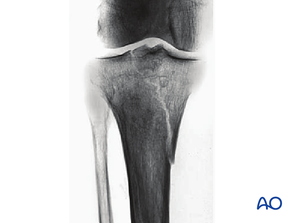 Oblique split, involving the tibial spines and one of the tibial plateaus (AO/OTA 41B1.3)