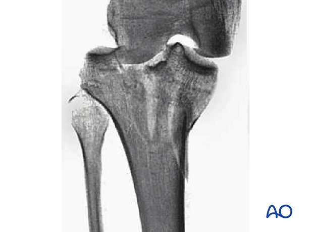 Oblique split depression, involving the tibial spines and one of the surfaces (AO/OTA 41B3.3)