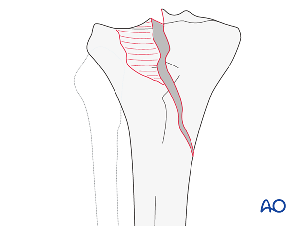 Oblique split depression, involving the tibial spines and one of the surfaces (AO/OTA 41B3.3)