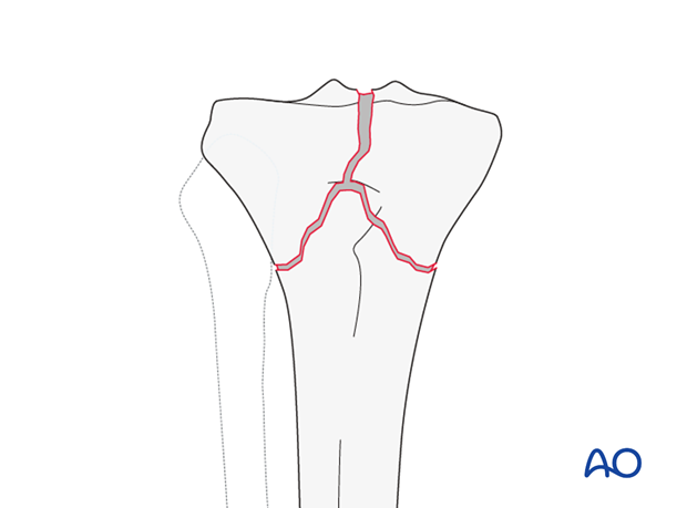 Complete articular fracture, simple articular, simple metaphyseal (AO/OTA 41C1)
