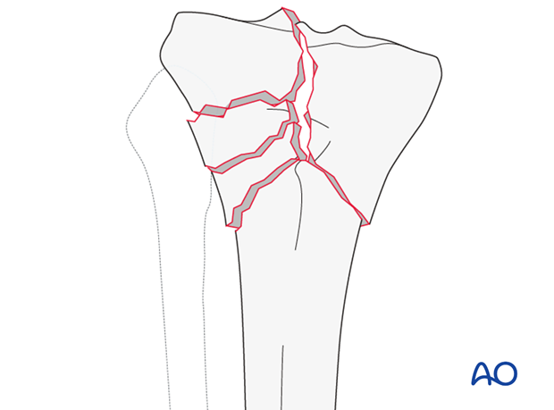 Complete articular fracture, simple articular, multifragmentary metaphyseal (AO/OTA 41C2)
