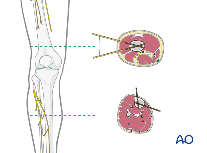 Bridging external fixator (temporary) for Complete articular fracture ...