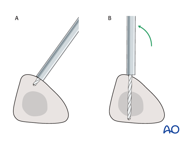 Bridging external fixator (temporary) for Complete articular fracture ...
