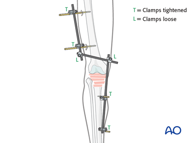 Bridging external fixator (temporary) for Complete articular fracture ...