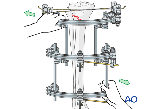 Ring external fixator (definitive) for Complete articular fracture,  fragmentary articular