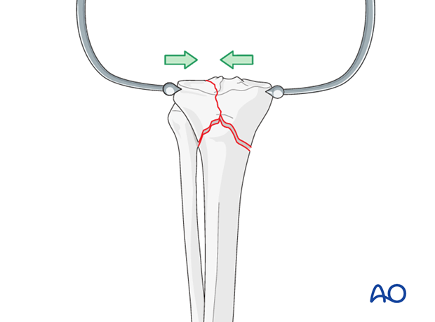 Ring external fixator (definitive) for Complete articular fracture