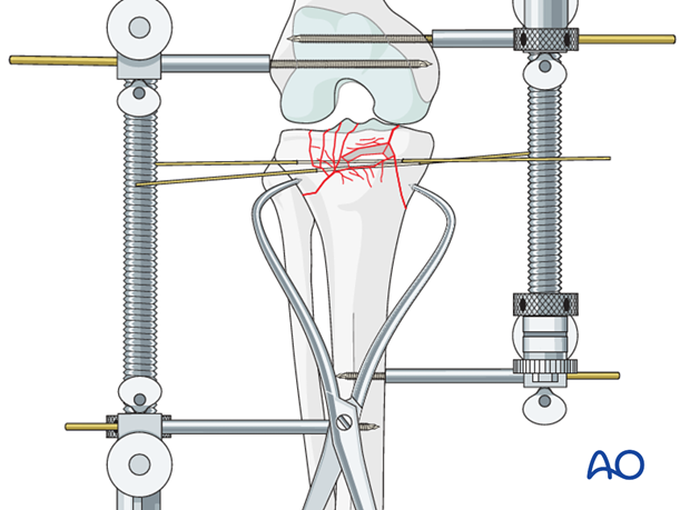 Ring external fixator (definitive) for Complete articular fracture,  fragmentary articular