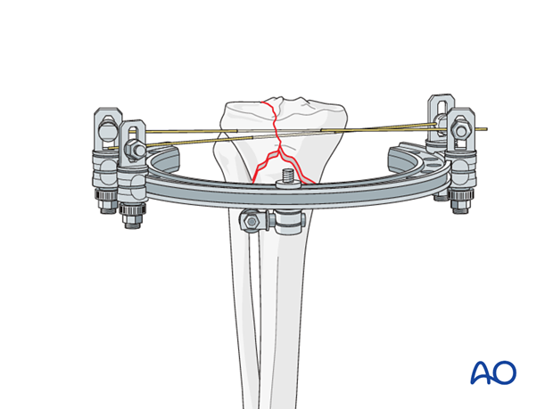 Ring external fixator (definitive) for Complete articular fracture