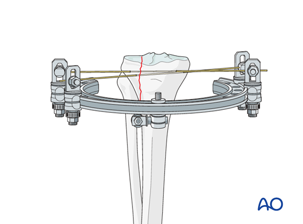 Circular external fixator application for midshaft tibial