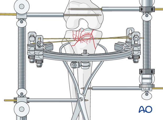 Ring external fixator (definitive) for Complete articular fracture