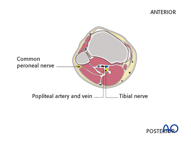 Ring external fixator (definitive) for Complete articular fracture,  fragmentary articular