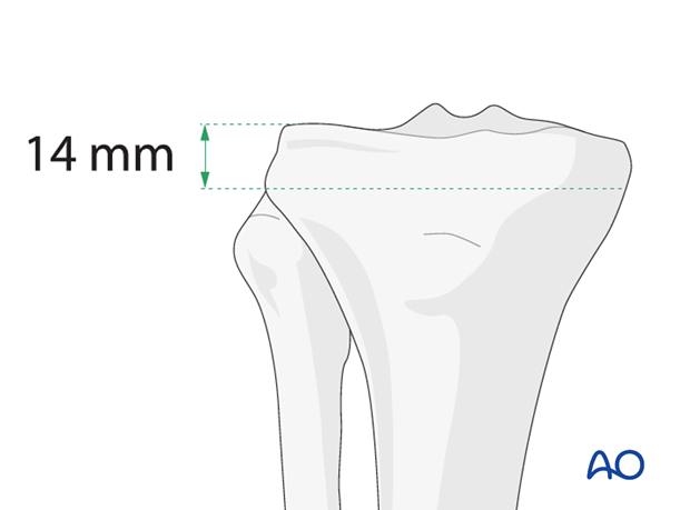 Ring external fixator (definitive) for Complete articular fracture