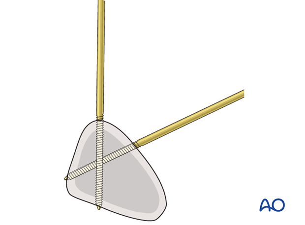 Schanz screw insertion