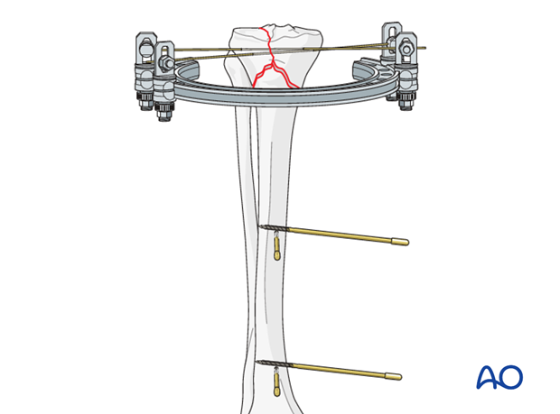 Ring external fixator (definitive) for Complete articular fracture