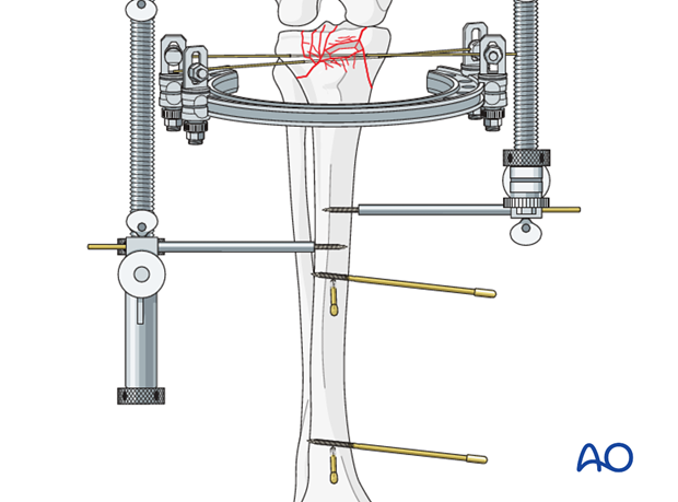 Ring external fixator (definitive) for Complete articular fracture