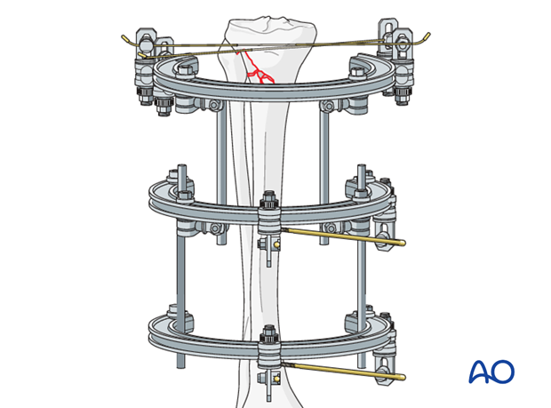 Full ring external fixation (Ilizarov) for Extraarticular, wedge