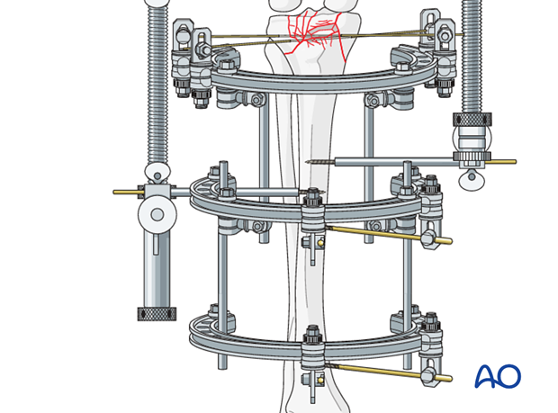 Full ring external fixation (Ilizarov) for Extraarticular, wedge fracture