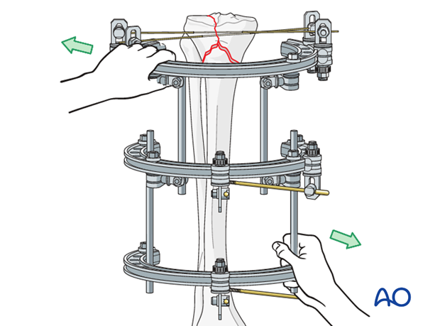 Ring external fixator (definitive) for Complete articular fracture