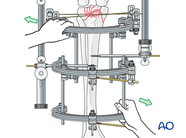 Ring external fixator (definitive) for Complete articular fracture