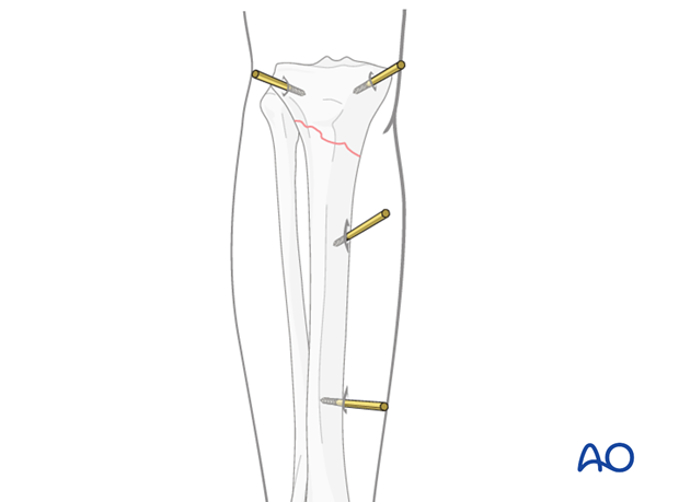 non bridging external fixator definitive
