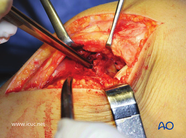 By elevating the patella with the knee extended, the avulsed tibial spine can be seen.