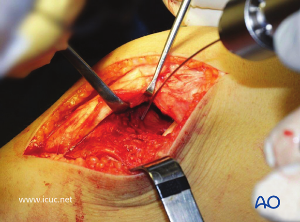 The hematoma has been removed from beneath the avulsed tibial spine and it has been reduced and held with a K-wire.