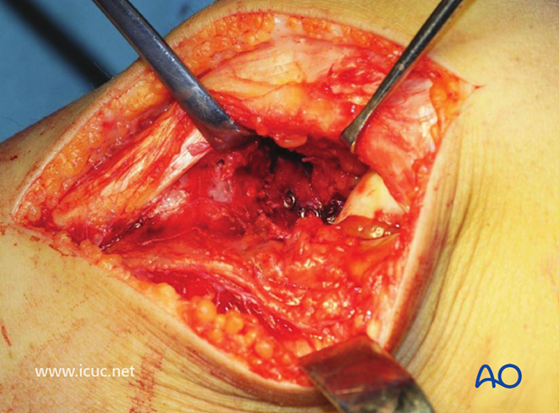 Final intraoperative view of the tibial plateau