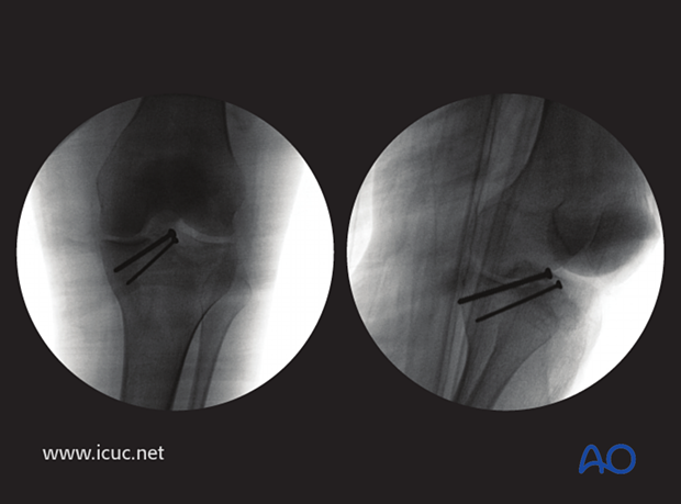 Intraoperative check X-rays in two views
