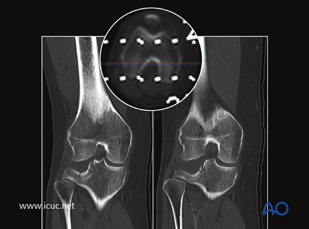Two images from CT showing the severe lateral tibial depression