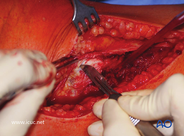 The anterior compartment has been opened and the surgeon is performing a subperiosteal dissection of the anterolateral tibial plateau.