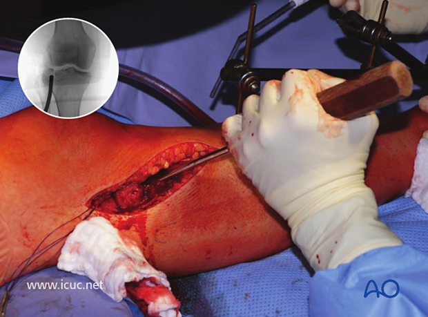 The disimpaction tool is inserted under fluoroscopic guidance and a large area is created underneath the fracture to ensure the whole impacted joint surface is lifted as one large piece.